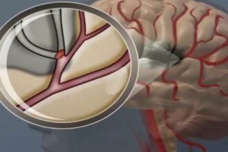 Ilustrasi aliran darah tersumbat di otak. (american stroke association)
