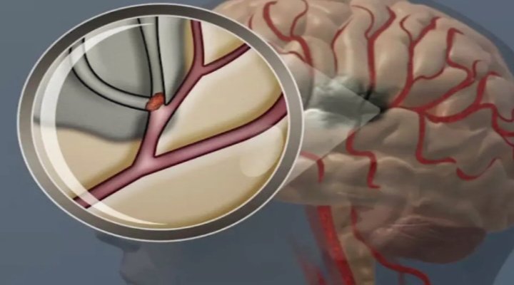 Ilustrasi aliran darah tersumbat di otak. (american stroke association)