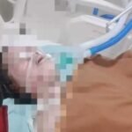 Korban HA dirawat intensif di ruang perawatan rumah sakit di Makassar, Selasa (23/2/2026), usai mengalami luka bakar serius dalam peristiwa yang tengah diselidiki aparat kepolisian.